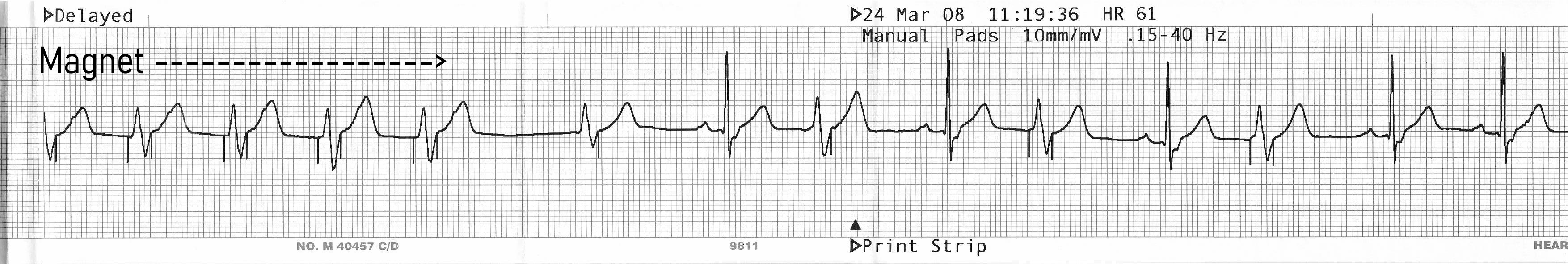 Undersensing Pacemaker Rythm Cardiac Rhythm Device Troubleshooting